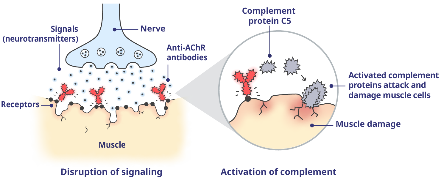 Harmful antibodies disrupt these signals and activate the complement system, resulting in damage to the muscle cells and the symptoms of gMG.